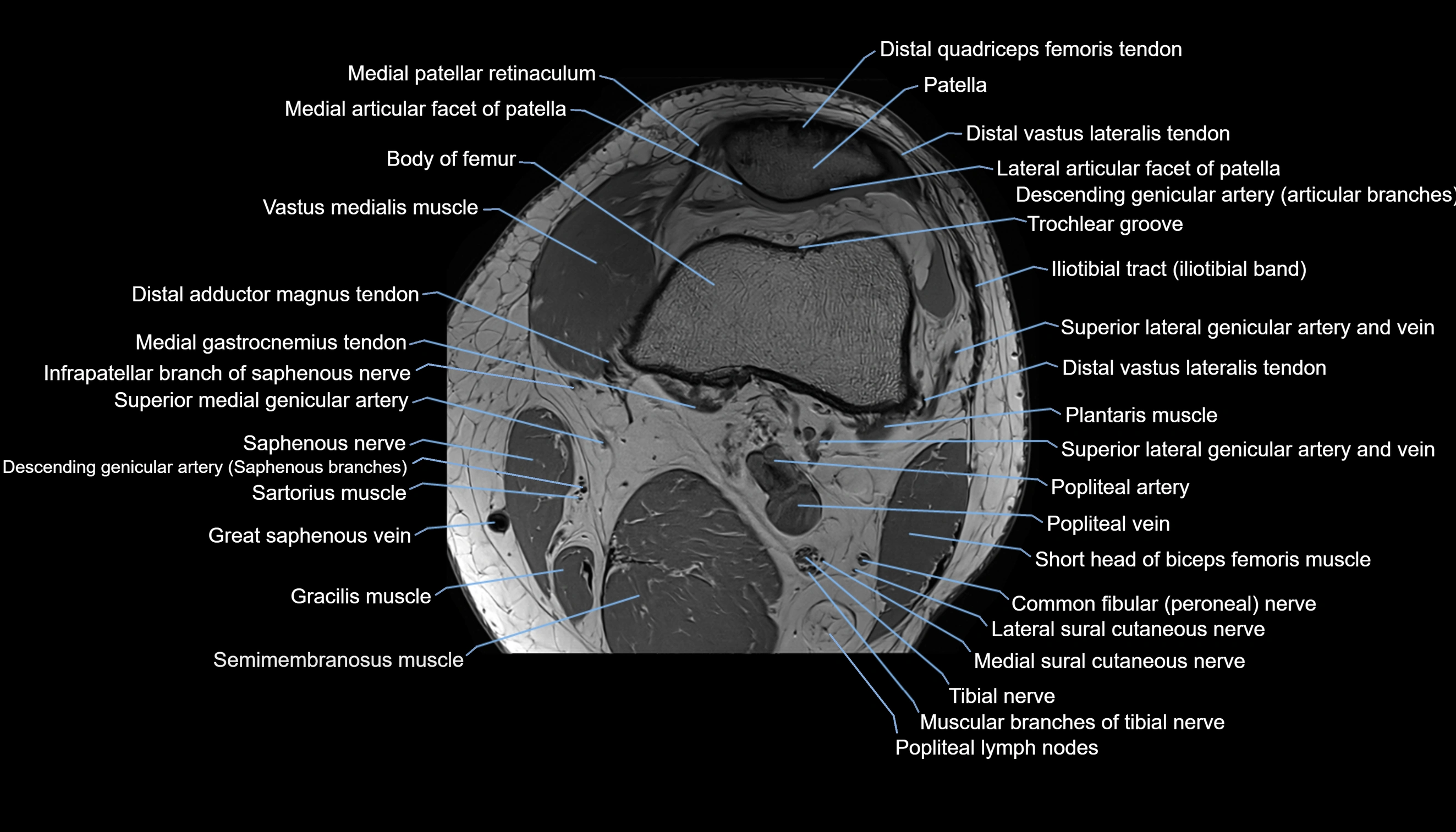 MRI knee  axial cross sectional anatomy 3T radiology  image-img-00001-00010.webp
